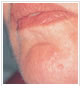 chin fibroma